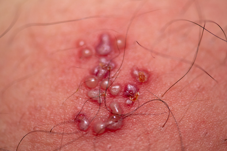 헤르페스가 입맞춤, 구강 성접촉, 성기 접촉, 병변 부위 직접 접촉으로 전파될 수 있음을 설명하는 이미지